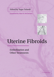 Uterine Fibroids Embolization And Other Treatments | Obstetrics And ...