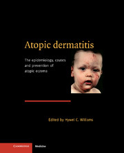 atopic dermatitis causes