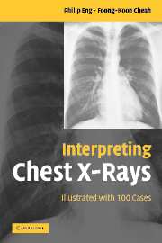 How To Read A Chest X-ray PDF: ABCDE Mnemonic, Step By Step, 56% OFF