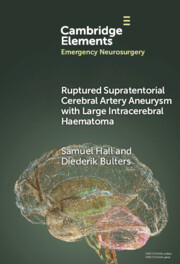 Ruptured Supratentorial Cerebral Artery Aneurysm with Large Intracerebral Haematoma