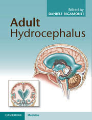 hydrocephalus adult shunt access cambridge