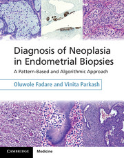 Diagnosis of Neoplasia in Endometrial Biopsies