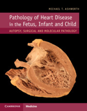 Pathology of Heart Disease in the Fetus, Infant and Child