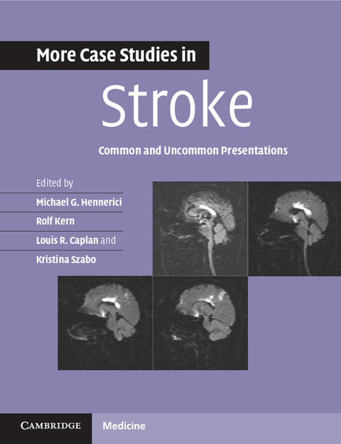 sample stroke case study