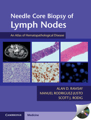Needle Core Biopsy of Lymph Nodes