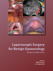Laparoscopic Surgery for Benign Gynaecology